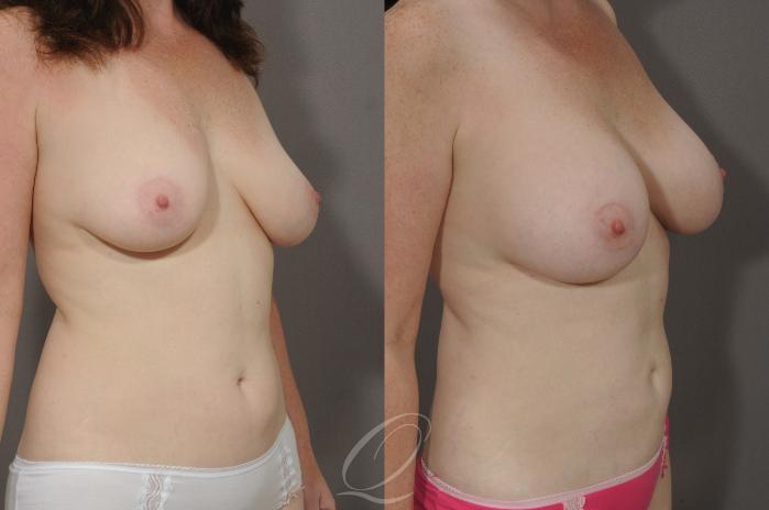 Breast Augmentation Case 1070 Before & After View #2 | Serving Rochester, Syracuse & Buffalo, NY | Quatela Center for Plastic Surgery