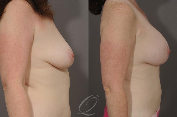 Breast Augmentation Case 1070 Before & After View #3 | Serving Rochester, Syracuse & Buffalo, NY | Quatela Center for Plastic Surgery