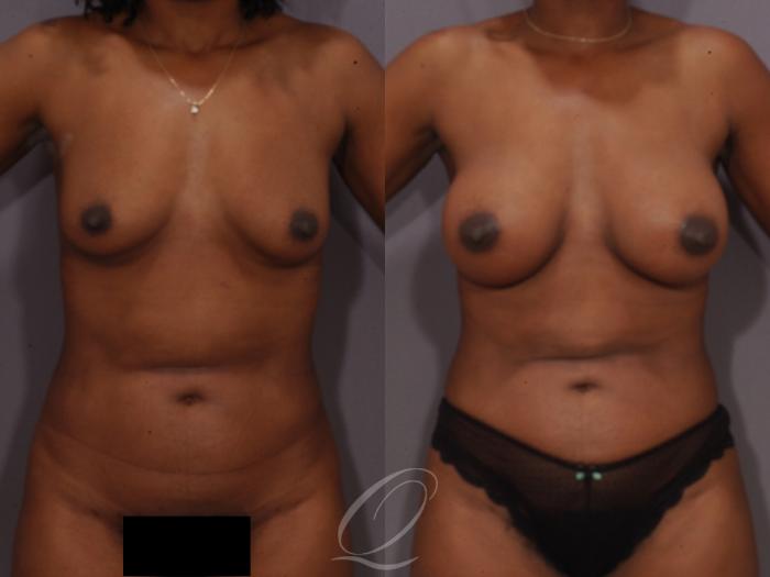 Breast Augmentation Case 1071 Before & After View #1 | Serving Rochester, Syracuse & Buffalo, NY | Quatela Center for Plastic Surgery
