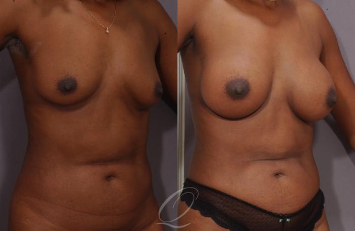 Breast Augmentation Case 1071 Before & After View #2 | Serving Rochester, Syracuse & Buffalo, NY | Quatela Center for Plastic Surgery