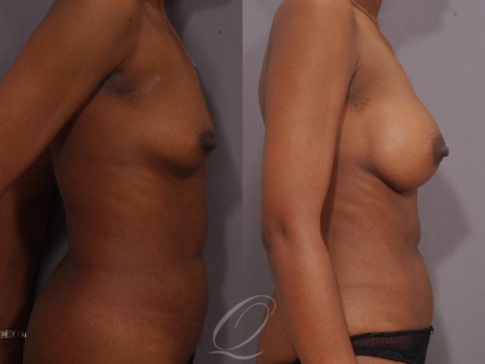 Breast Augmentation Case 1071 Before & After View #3 | Serving Rochester, Syracuse & Buffalo, NY | Quatela Center for Plastic Surgery