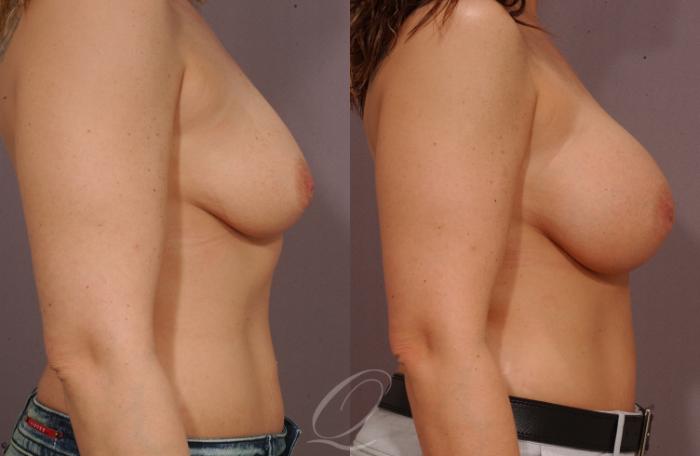 Breast Augmentation Case 1074 Before & After View #3 | Serving Rochester, Syracuse & Buffalo, NY | Quatela Center for Plastic Surgery