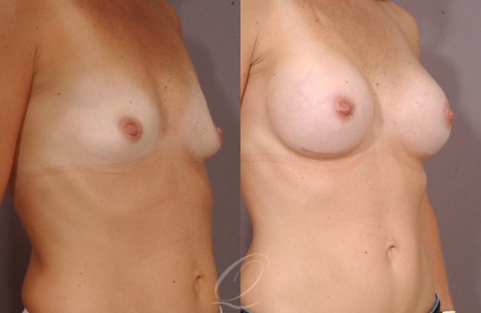 Breast Augmentation Case 1075 Before & After View #2 | Serving Rochester, Syracuse & Buffalo, NY | Quatela Center for Plastic Surgery