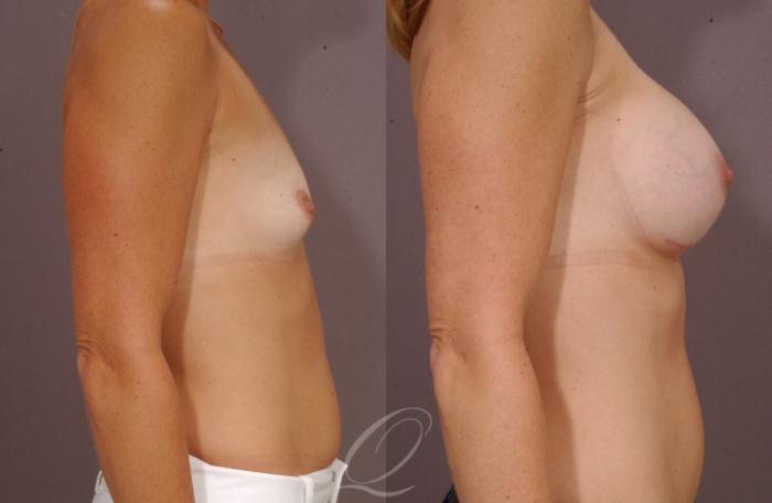 Breast Augmentation Case 1075 Before & After View #3 | Serving Rochester, Syracuse & Buffalo, NY | Quatela Center for Plastic Surgery