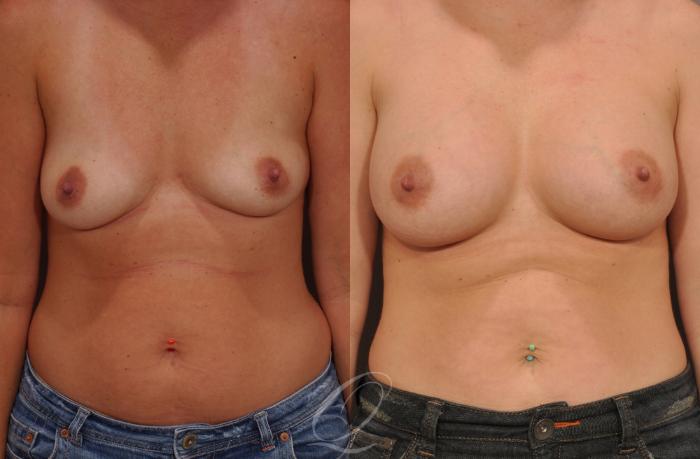 Breast Augmentation Case 1076 Before & After View #1 | Serving Rochester, Syracuse & Buffalo, NY | Quatela Center for Plastic Surgery