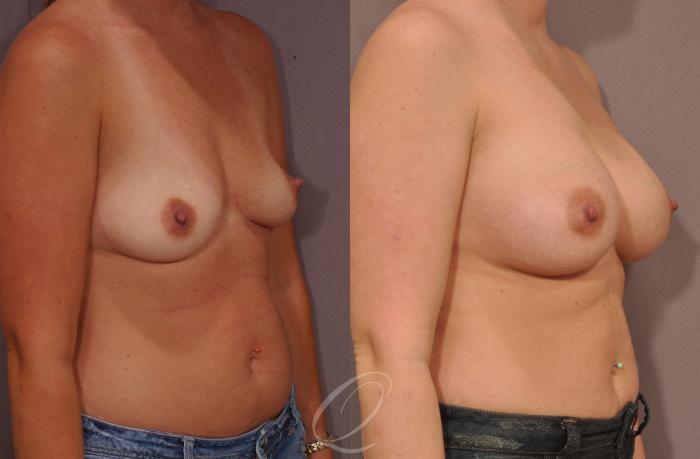 Breast Augmentation Case 1076 Before & After View #2 | Serving Rochester, Syracuse & Buffalo, NY | Quatela Center for Plastic Surgery
