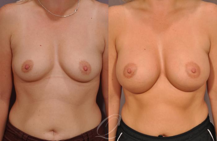 Breast Augmentation Case 1077 Before & After View #1 | Serving Rochester, Syracuse & Buffalo, NY | Quatela Center for Plastic Surgery