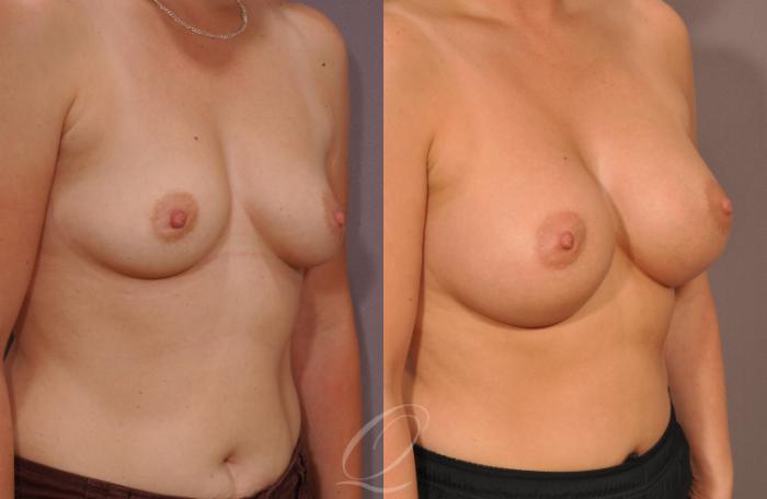 Breast Augmentation Case 1077 Before & After View #2 | Serving Rochester, Syracuse & Buffalo, NY | Quatela Center for Plastic Surgery
