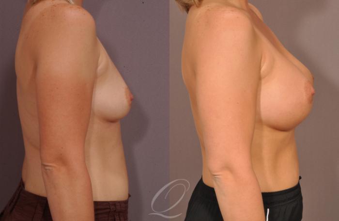 Breast Augmentation Case 1077 Before & After View #3 | Serving Rochester, Syracuse & Buffalo, NY | Quatela Center for Plastic Surgery