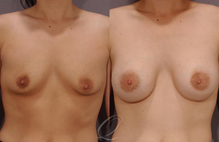 Breast Augmentation Case 1078 Before & After View #1 | Serving Rochester, Syracuse & Buffalo, NY | Quatela Center for Plastic Surgery