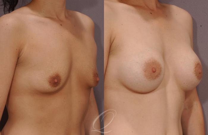 Breast Augmentation Case 1078 Before & After View #2 | Serving Rochester, Syracuse & Buffalo, NY | Quatela Center for Plastic Surgery