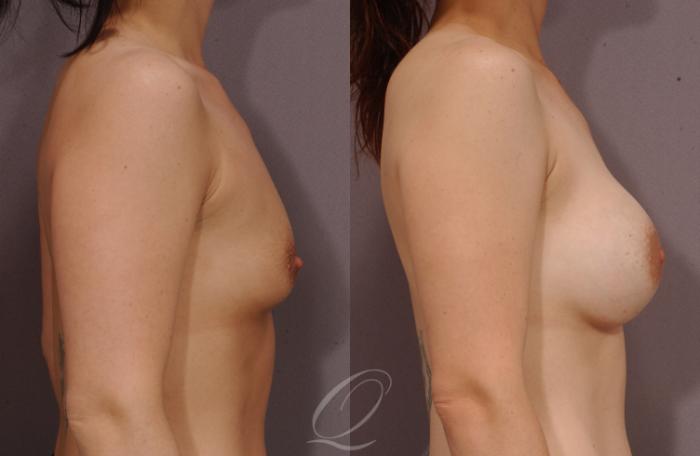 Breast Augmentation Case 1078 Before & After View #3 | Serving Rochester, Syracuse & Buffalo, NY | Quatela Center for Plastic Surgery