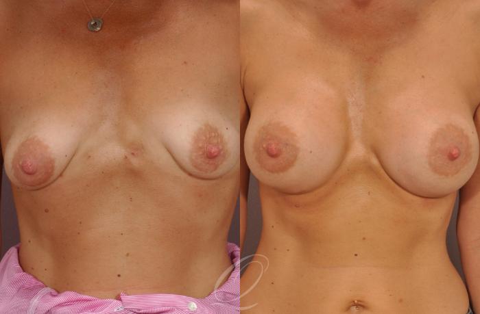Breast Augmentation Case 1079 Before & After View #1 | Serving Rochester, Syracuse & Buffalo, NY | Quatela Center for Plastic Surgery