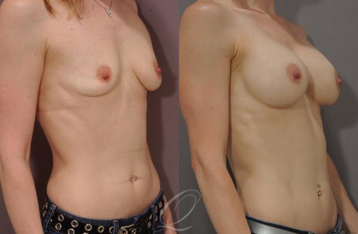 Breast Augmentation Case 1081 Before & After View #2 | Serving Rochester, Syracuse & Buffalo, NY | Quatela Center for Plastic Surgery