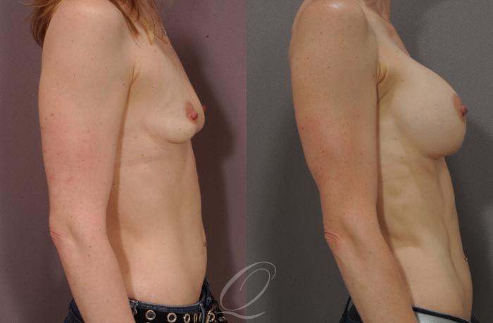 Breast Augmentation Case 1081 Before & After View #3 | Serving Rochester, Syracuse & Buffalo, NY | Quatela Center for Plastic Surgery