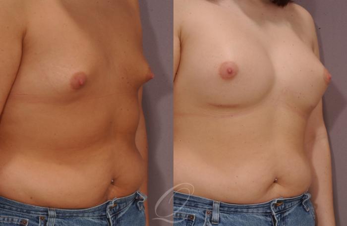 Breast Augmentation Case 1083 Before & After View #2 | Serving Rochester, Syracuse & Buffalo, NY | Quatela Center for Plastic Surgery