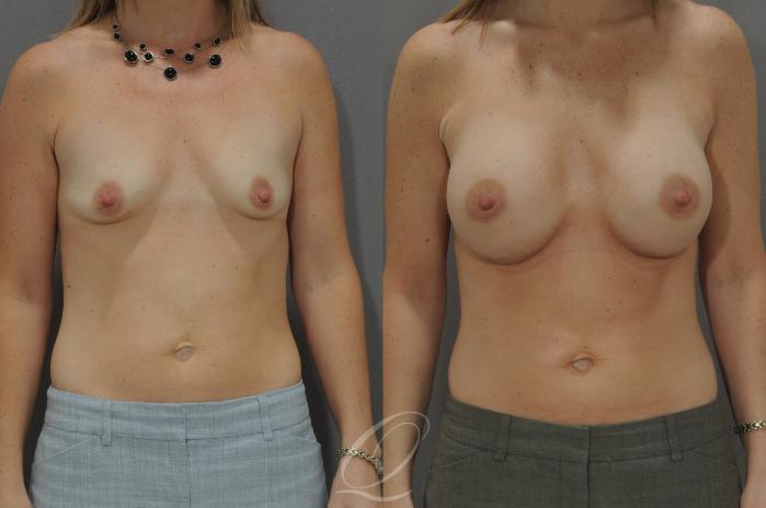 Breast Augmentation Case 1084 Before & After View #1 | Serving Rochester, Syracuse & Buffalo, NY | Quatela Center for Plastic Surgery