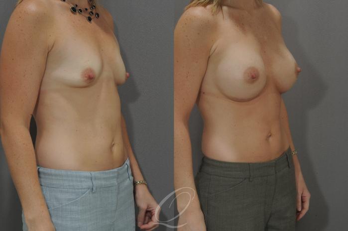 Breast Augmentation Case 1084 Before & After View #2 | Serving Rochester, Syracuse & Buffalo, NY | Quatela Center for Plastic Surgery