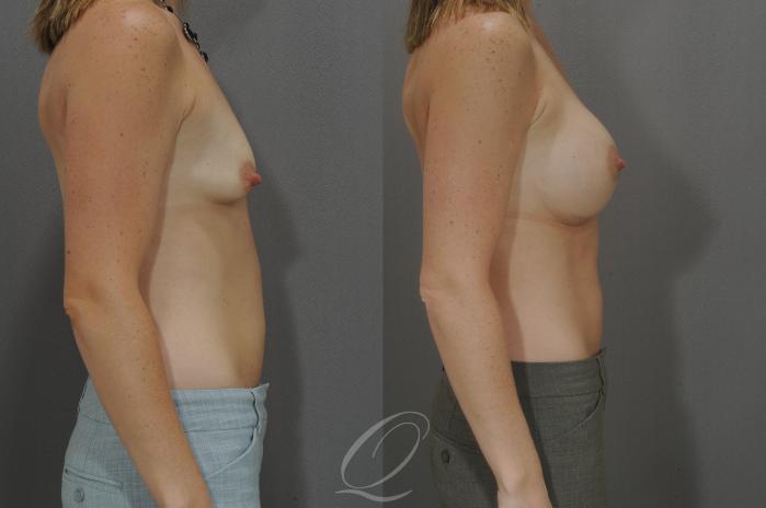 Breast Augmentation Case 1084 Before & After View #3 | Serving Rochester, Syracuse & Buffalo, NY | Quatela Center for Plastic Surgery