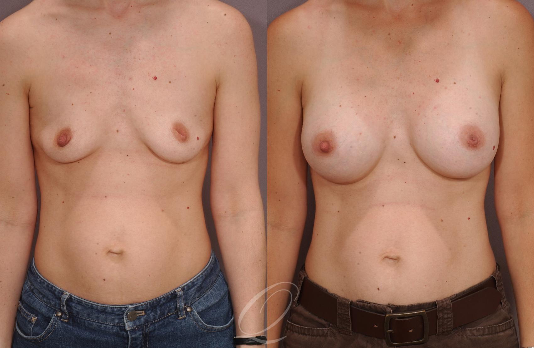Breast Augmentation Case 1085 Before & After View #1 | Serving Rochester, Syracuse & Buffalo, NY | Quatela Center for Plastic Surgery