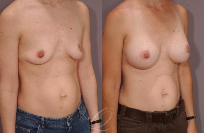 Breast Augmentation Case 1085 Before & After View #2 | Serving Rochester, Syracuse & Buffalo, NY | Quatela Center for Plastic Surgery