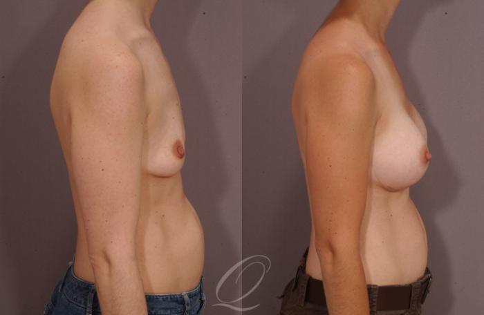 Breast Augmentation Case 1085 Before & After View #3 | Serving Rochester, Syracuse & Buffalo, NY | Quatela Center for Plastic Surgery