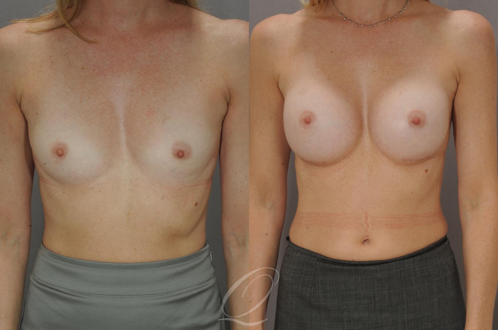 Breast Augmentation Case 1086 Before & After View #1 | Serving Rochester, Syracuse & Buffalo, NY | Quatela Center for Plastic Surgery