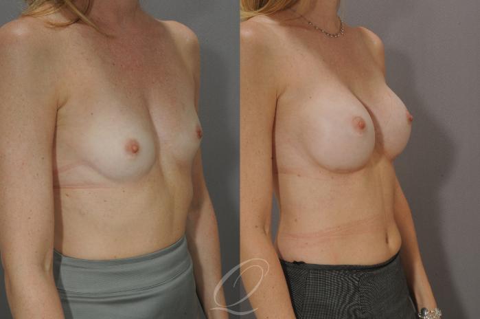 Breast Augmentation Case 1086 Before & After View #2 | Serving Rochester, Syracuse & Buffalo, NY | Quatela Center for Plastic Surgery