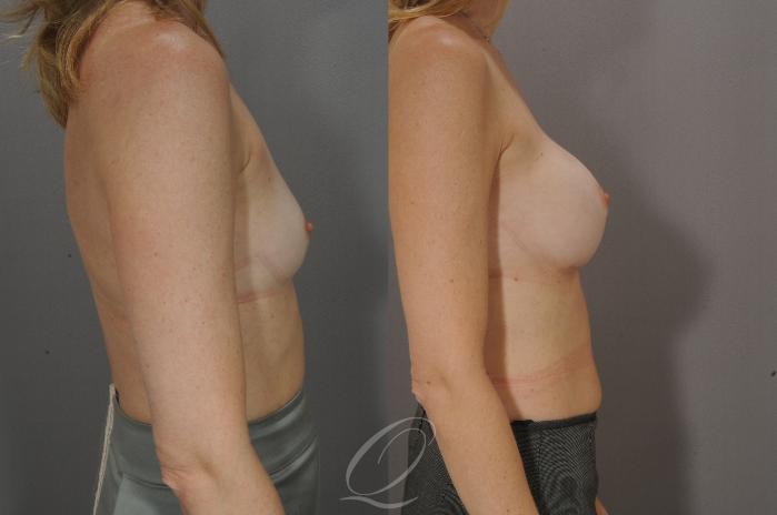 Breast Augmentation Case 1086 Before & After View #3 | Serving Rochester, Syracuse & Buffalo, NY | Quatela Center for Plastic Surgery