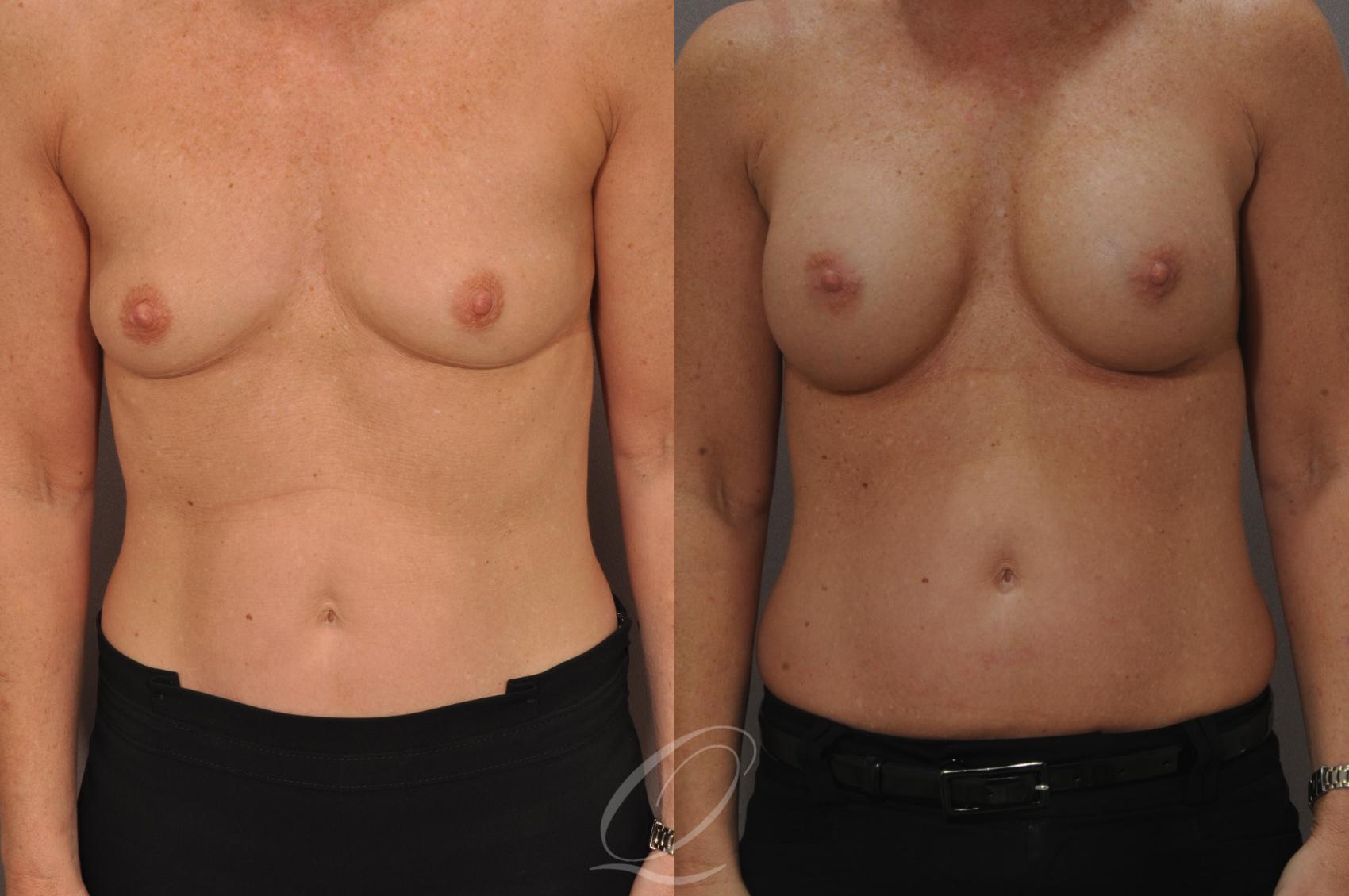 Breast Augmentation Case 1087 Before & After View #1 | Serving Rochester, Syracuse & Buffalo, NY | Quatela Center for Plastic Surgery