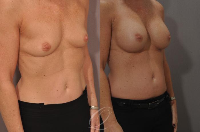 Breast Augmentation Case 1087 Before & After View #2 | Serving Rochester, Syracuse & Buffalo, NY | Quatela Center for Plastic Surgery