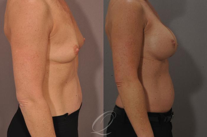 Breast Augmentation Case 1087 Before & After View #3 | Serving Rochester, Syracuse & Buffalo, NY | Quatela Center for Plastic Surgery