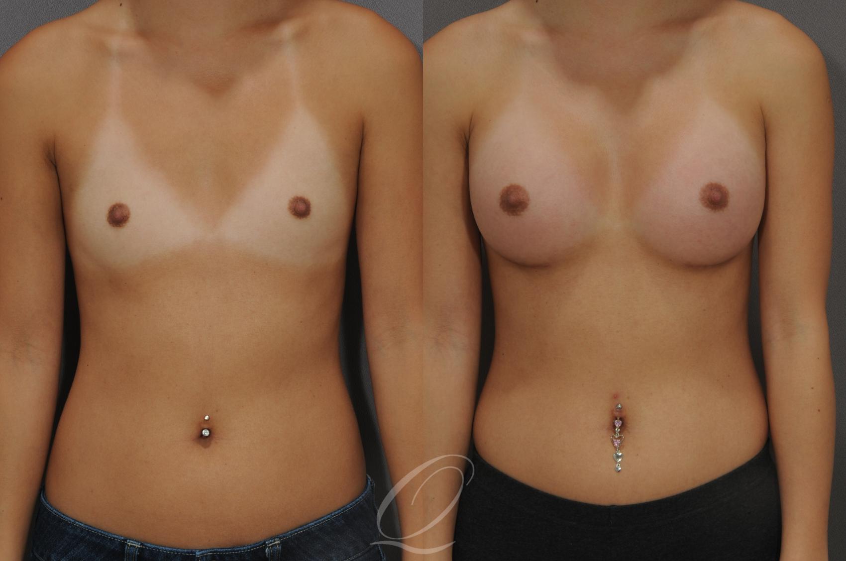 Breast Augmentation Case 1089 Before & After View #1 | Serving Rochester, Syracuse & Buffalo, NY | Quatela Center for Plastic Surgery