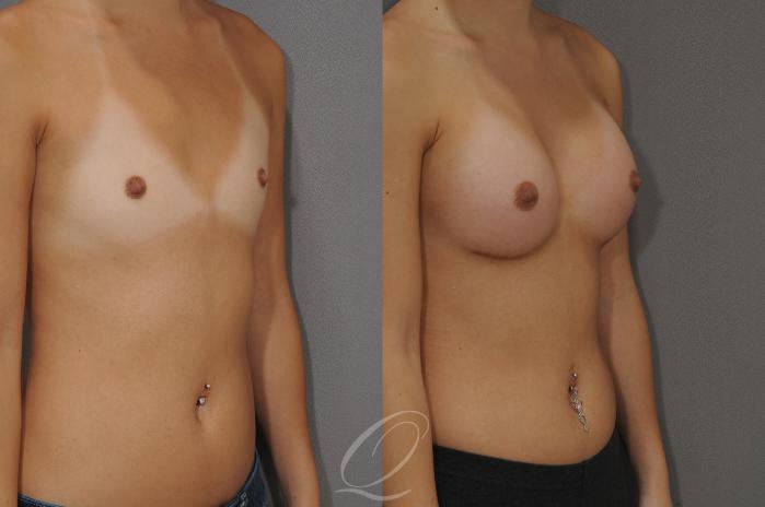 Breast Augmentation Case 1089 Before & After View #2 | Serving Rochester, Syracuse & Buffalo, NY | Quatela Center for Plastic Surgery