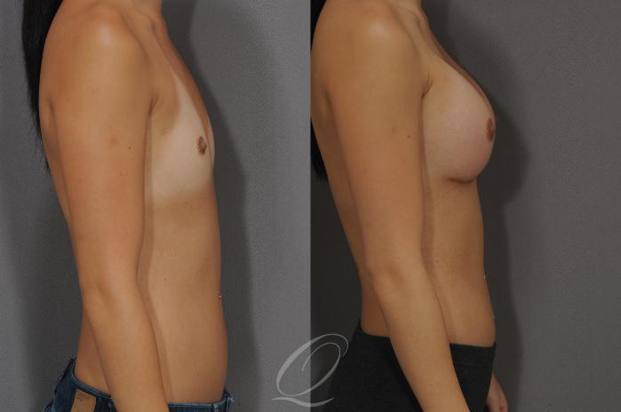 Breast Augmentation Case 1089 Before & After View #3 | Serving Rochester, Syracuse & Buffalo, NY | Quatela Center for Plastic Surgery
