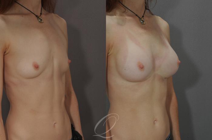 Breast Augmentation Case 1090 Before & After View #2 | Serving Rochester, Syracuse & Buffalo, NY | Quatela Center for Plastic Surgery