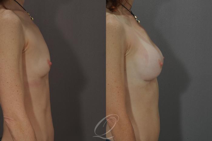 Breast Augmentation Case 1090 Before & After View #3 | Serving Rochester, Syracuse & Buffalo, NY | Quatela Center for Plastic Surgery