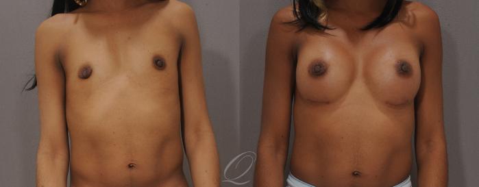 Breast Augmentation Case 1091 Before & After View #1 | Serving Rochester, Syracuse & Buffalo, NY | Quatela Center for Plastic Surgery