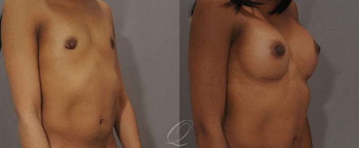 Breast Augmentation Case 1091 Before & After View #2 | Serving Rochester, Syracuse & Buffalo, NY | Quatela Center for Plastic Surgery