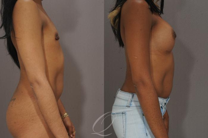 Breast Augmentation Case 1091 Before & After View #3 | Serving Rochester, Syracuse & Buffalo, NY | Quatela Center for Plastic Surgery