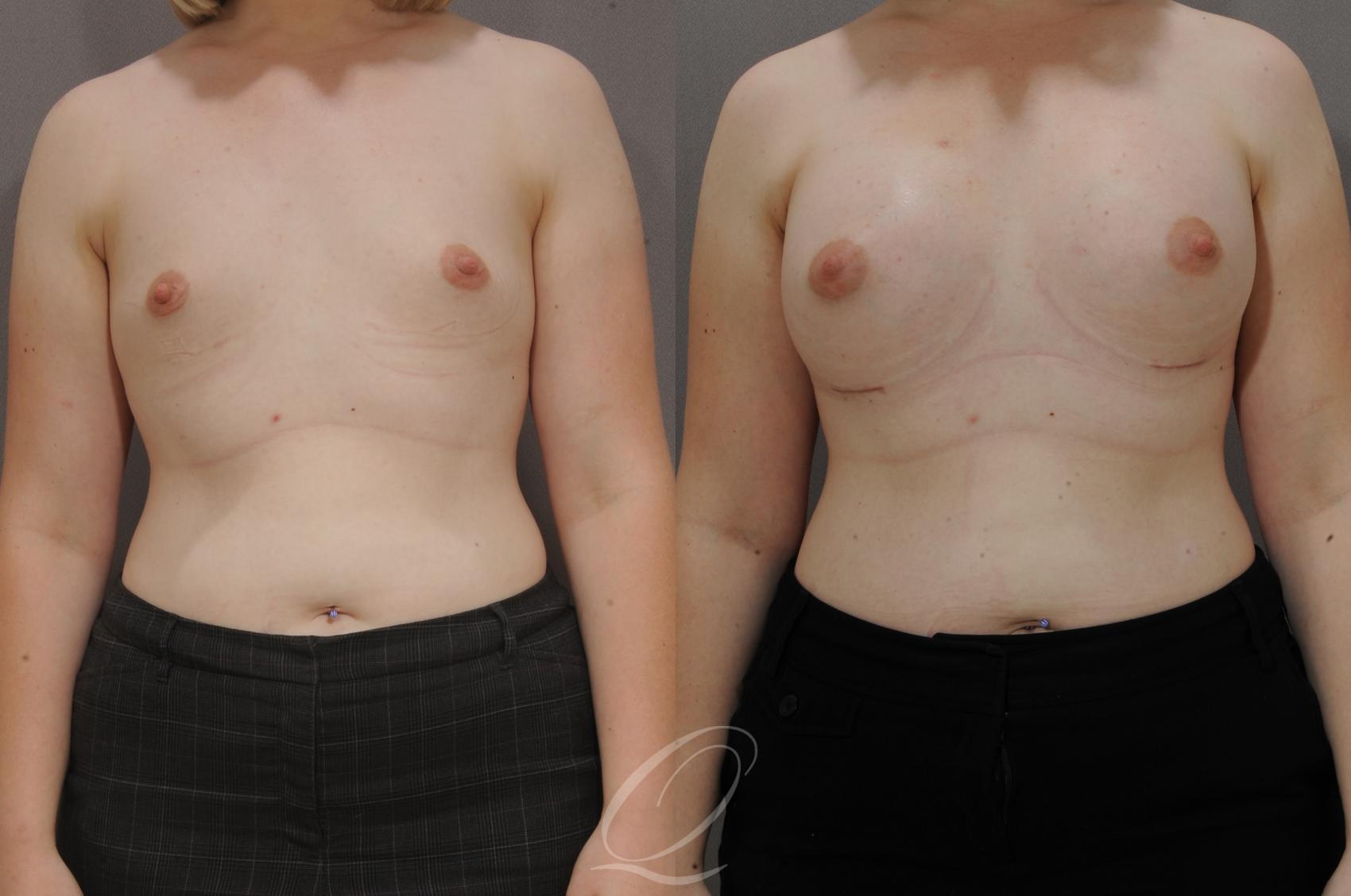 Breast Augmentation Case 1094 Before & After View #1 | Serving Rochester, Syracuse & Buffalo, NY | Quatela Center for Plastic Surgery