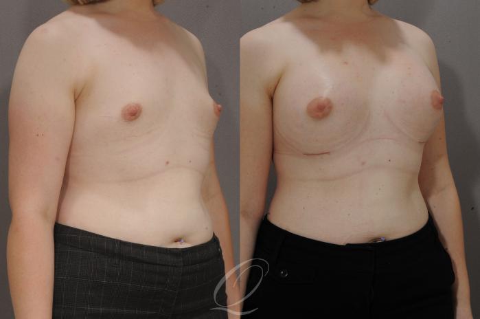 Breast Augmentation Case 1094 Before & After View #2 | Serving Rochester, Syracuse & Buffalo, NY | Quatela Center for Plastic Surgery