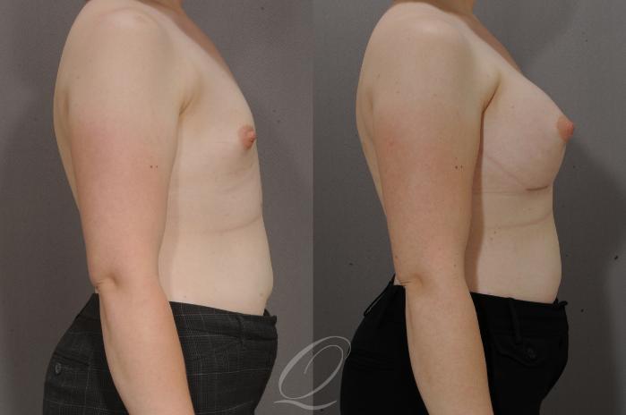 Breast Augmentation Case 1094 Before & After View #3 | Serving Rochester, Syracuse & Buffalo, NY | Quatela Center for Plastic Surgery