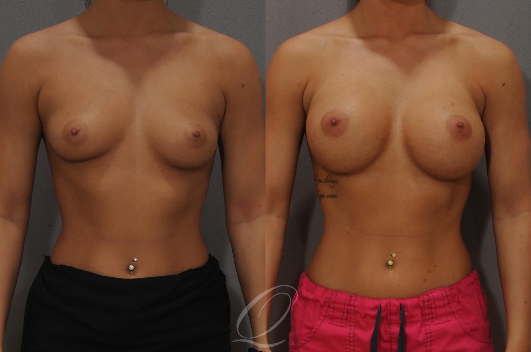Breast Augmentation Case 1096 Before & After View #1 | Serving Rochester, Syracuse & Buffalo, NY | Quatela Center for Plastic Surgery