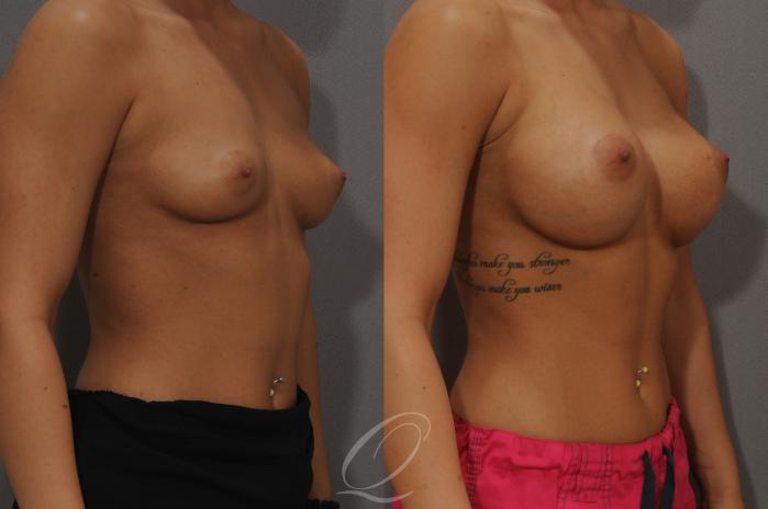 Breast Augmentation Case 1096 Before & After View #2 | Serving Rochester, Syracuse & Buffalo, NY | Quatela Center for Plastic Surgery