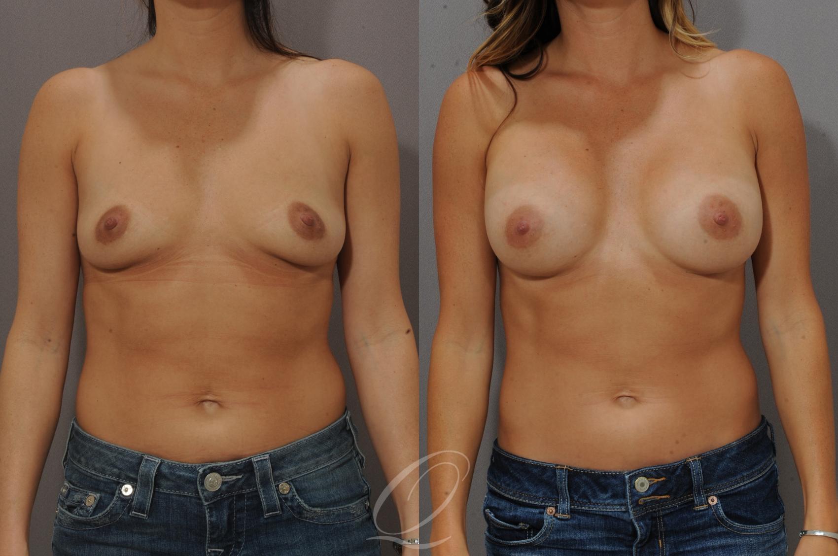 Breast Augmentation Case 1097 Before & After View #1 | Serving Rochester, Syracuse & Buffalo, NY | Quatela Center for Plastic Surgery