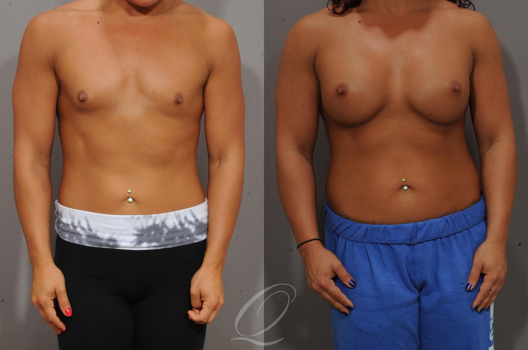 Breast Augmentation Before & After Photos Patient 1099