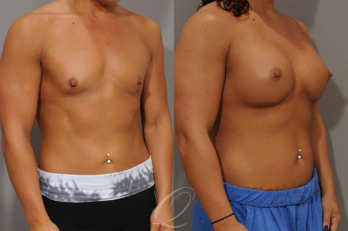 Breast Augmentation Case 1099 Before & After View #2 | Serving Rochester, Syracuse & Buffalo, NY | Quatela Center for Plastic Surgery