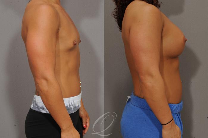 Breast Augmentation Before & After Photos Patient 1099, Serving Rochester,  Syracuse & Buffalo, NY