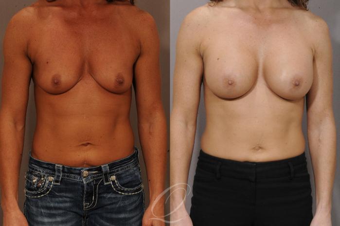 Breast Augmentation Case 1100 Before & After View #1 | Serving Rochester, Syracuse & Buffalo, NY | Quatela Center for Plastic Surgery